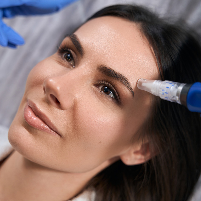 PRF Microneedling in Birmingham, AL | Pure Esthetics - CEB-Microneedling1